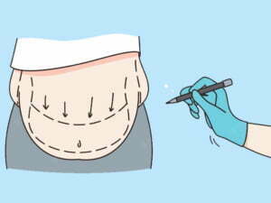 عمل ابدومینوپلاستی جراحی زیبایی شکم ابدو