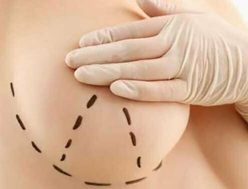 عمل لیفت و بالا کشیدن سینه زنان