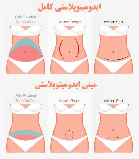 My tummy перевод. Tummy Tuck Full Mini.