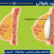 عوارض ایمپلنت سینه و پروتز