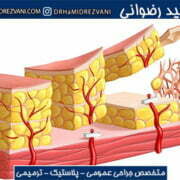 لیپوماتیک چیست