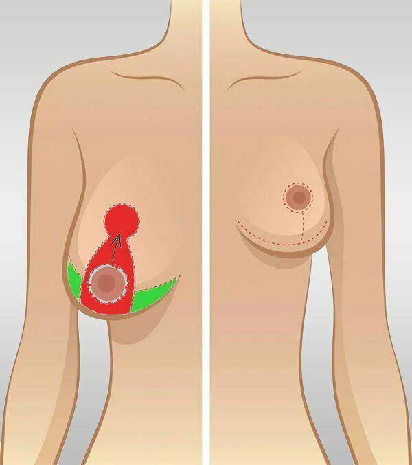 mammoplasty procedure
