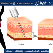 تفاوت لیپوماتیک و لیپوساکشن