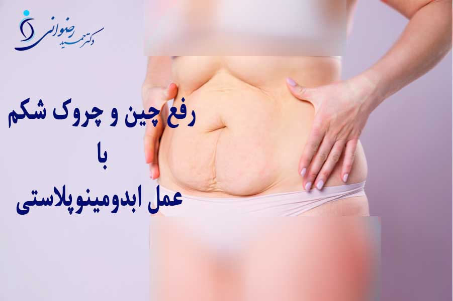 عمل ابدومینوپلاستی چیست - عمل ابدومینوپلاستی شکم برای رفع چین و چروک و زیبایی شکم