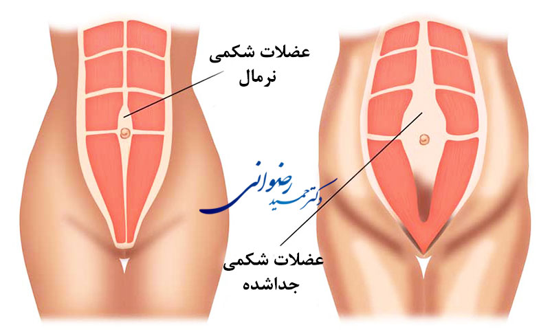ترمیم عضلات ضعیف شده شکم با عمل جراحی زیبایی شکمی