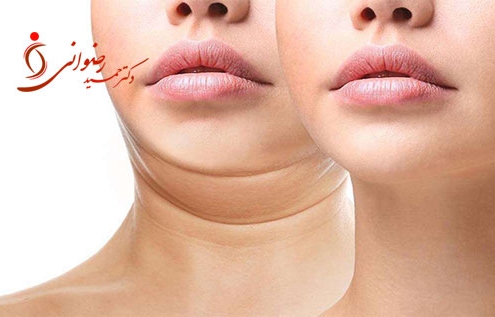 - دکتر حمید رضوانی لیپوساکشن غبغب و گردن