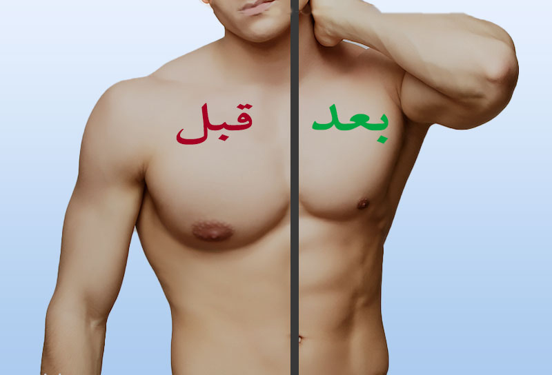 - دکتر حمید رضوانی عکس قبل و بعد عمل ژنیکوماستی