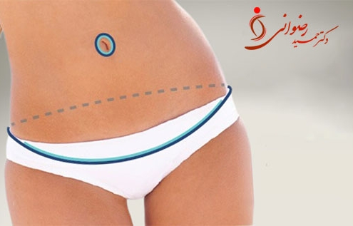 - دکتر حمید رضوانی ابدومینوپلاستی گسترده